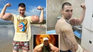 Nghệ sĩ thể hình Nga nguy cơ mất cả hai tay vì lạm dụng hóa chất